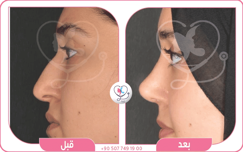 افضل دكتور تجميل أنف في سوريا لدى تركيا لاكشري كلينك