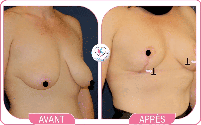 Cicatrices Lifting mammaire avant/après