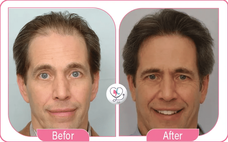 الخلايا الجذعية للشعر قبل وبعد