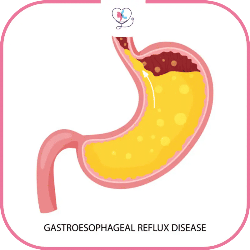 Qu'est-ce que le reflux gastrique ?