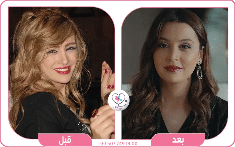 مرام علي قبل وبعد