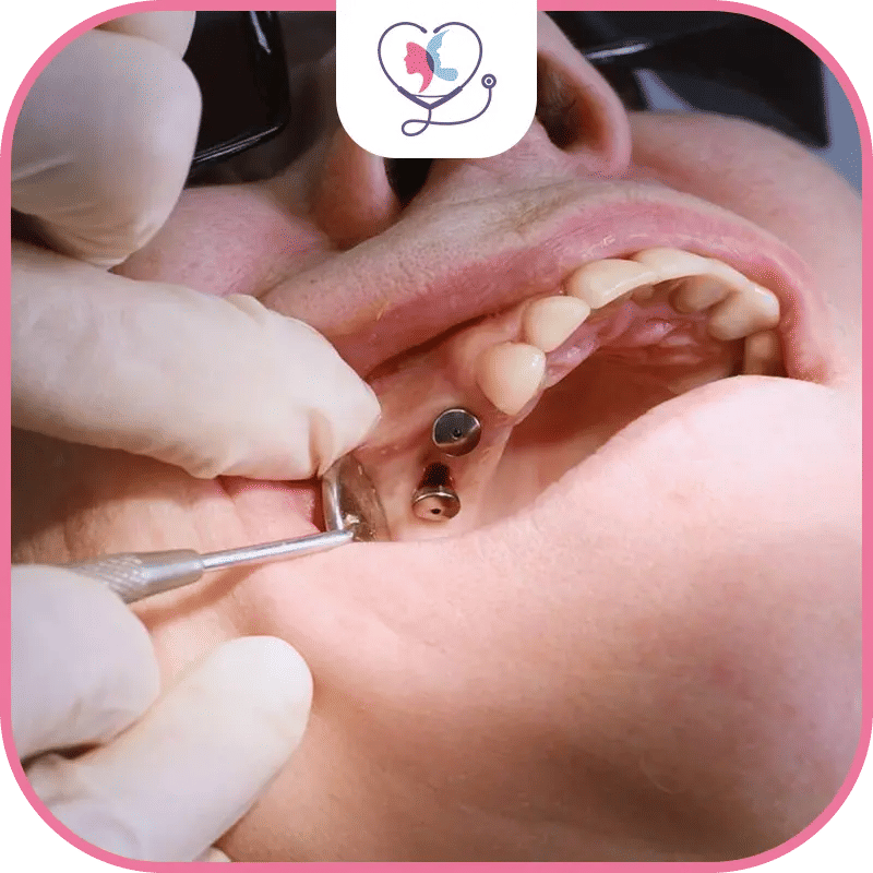 أنواع زراعة الأسنان في تركيا