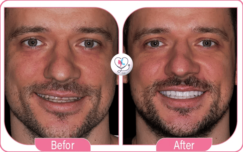 تجربتي مع تبييض الأسنان بالليزر بعد تقويم الأسنان