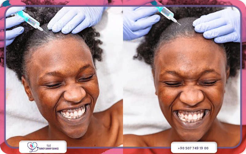 ماهي عملية زراعة الشعر الأفريقي؟