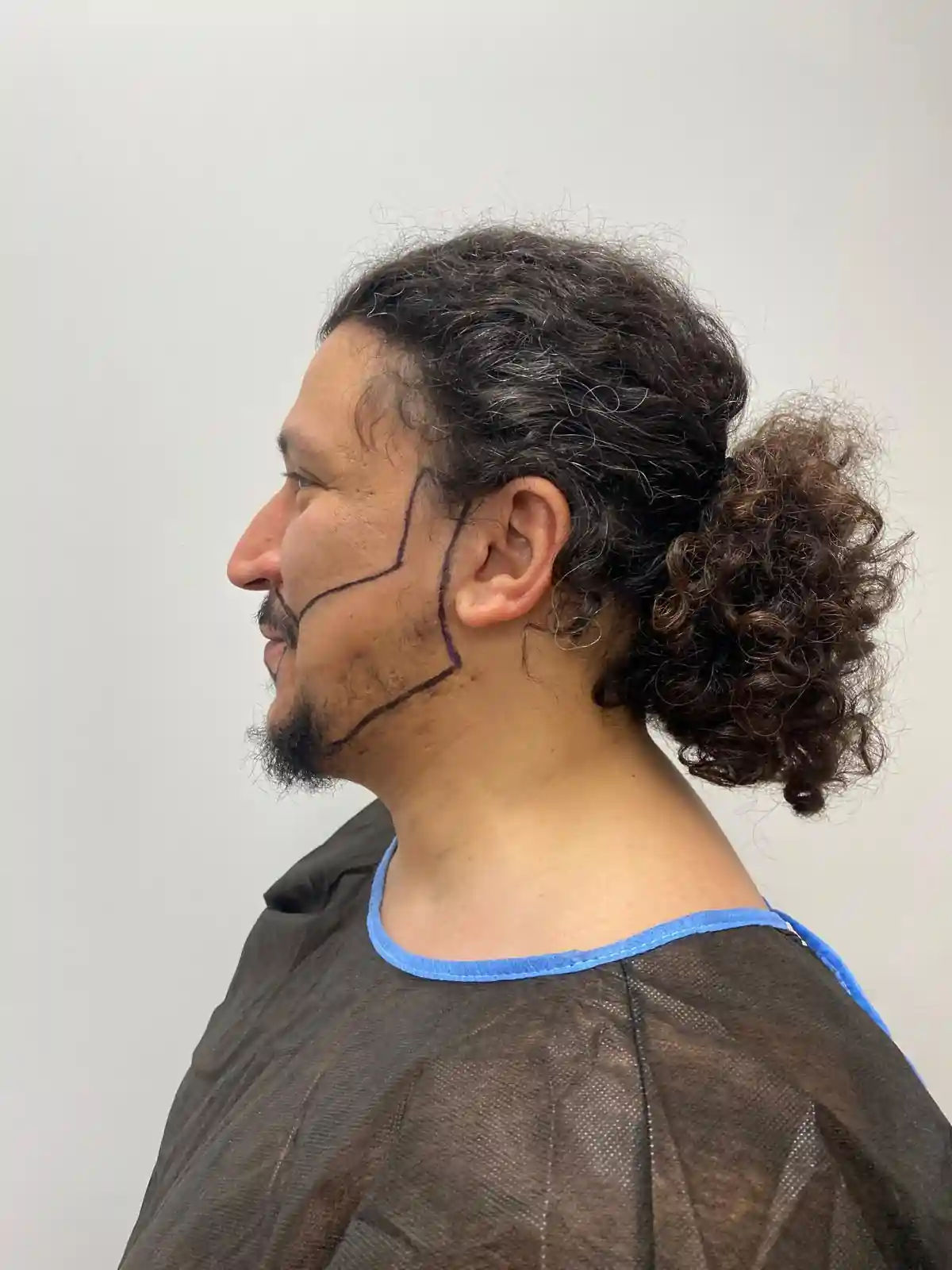 المرشحون لإجراء زراعة شعر الذقن