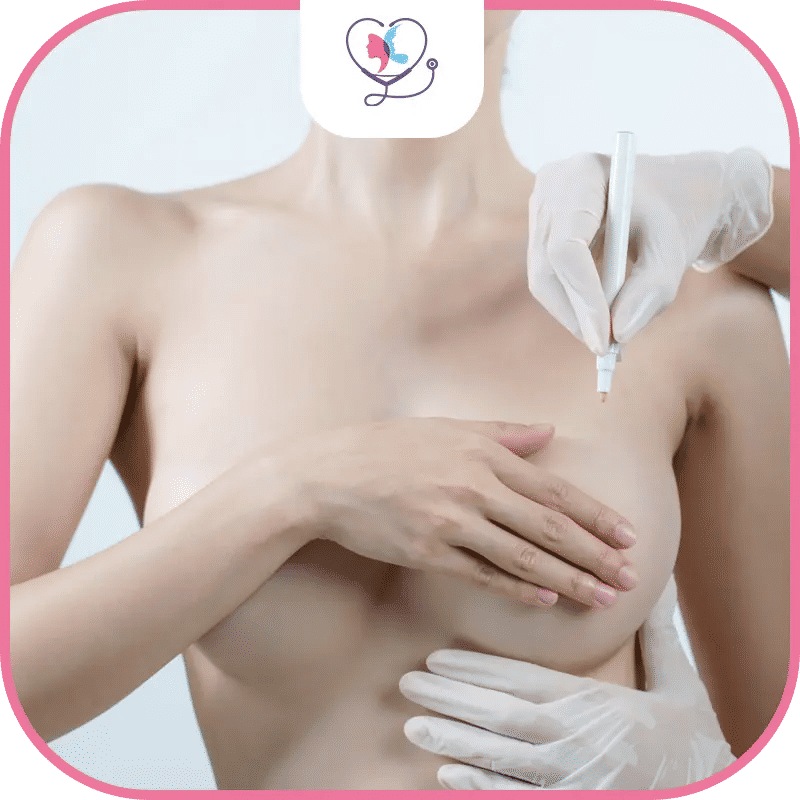 عملية شد ورفع الثدي