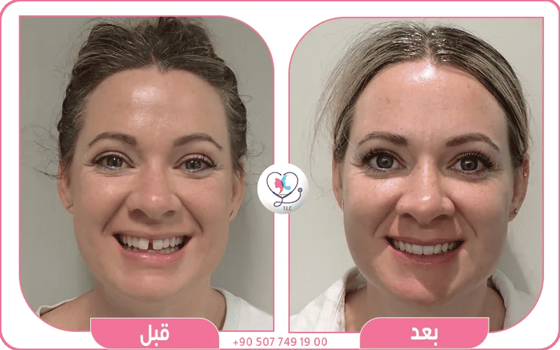 فراغ بين الأسنان الأمامية العلوية