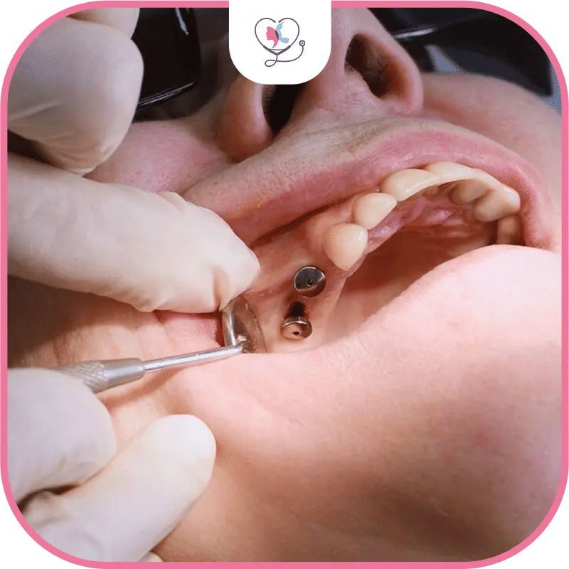 Top Dental Implant Brands in Turkey 2026