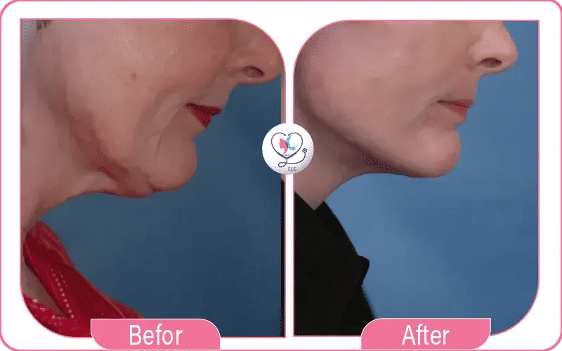 Turkey Neck Botox Before and After