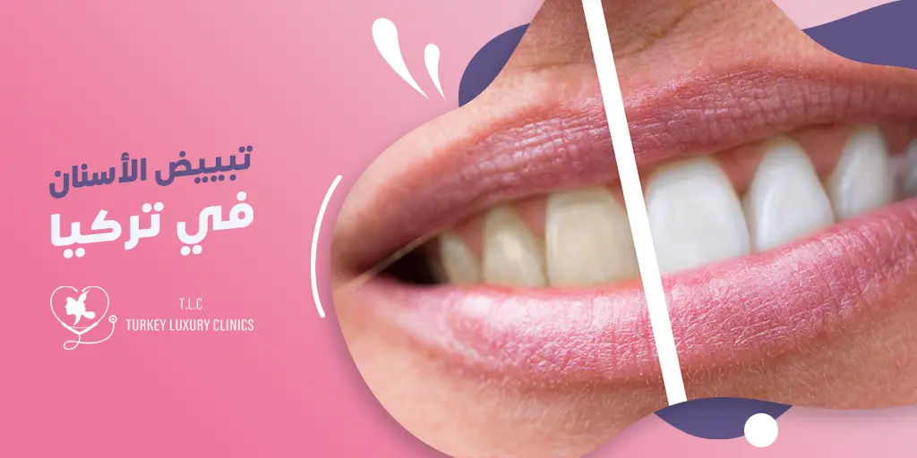 تبييض الأسنان في تركيا