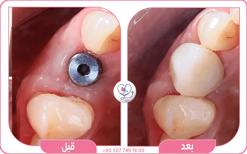 زراعة الأسنان في تركيا لاكشري كلينك