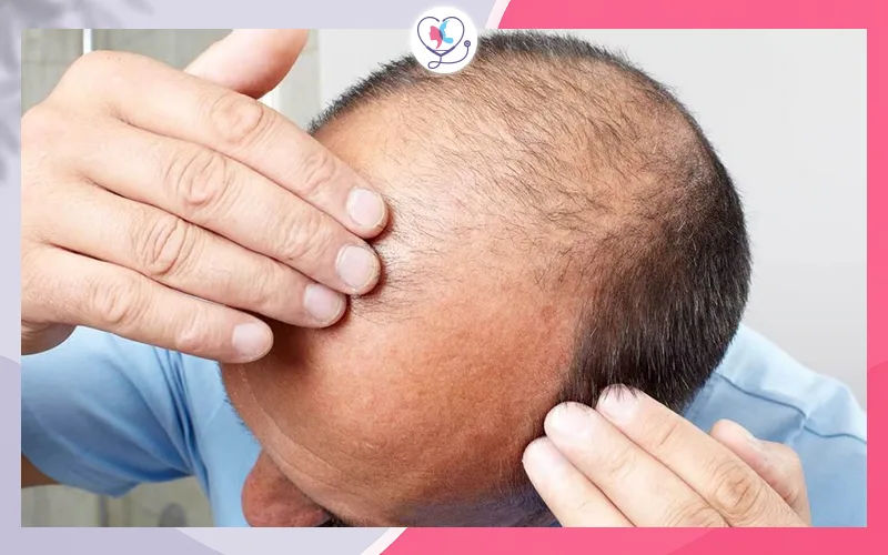متى يتساقط الشعر المزروع؟