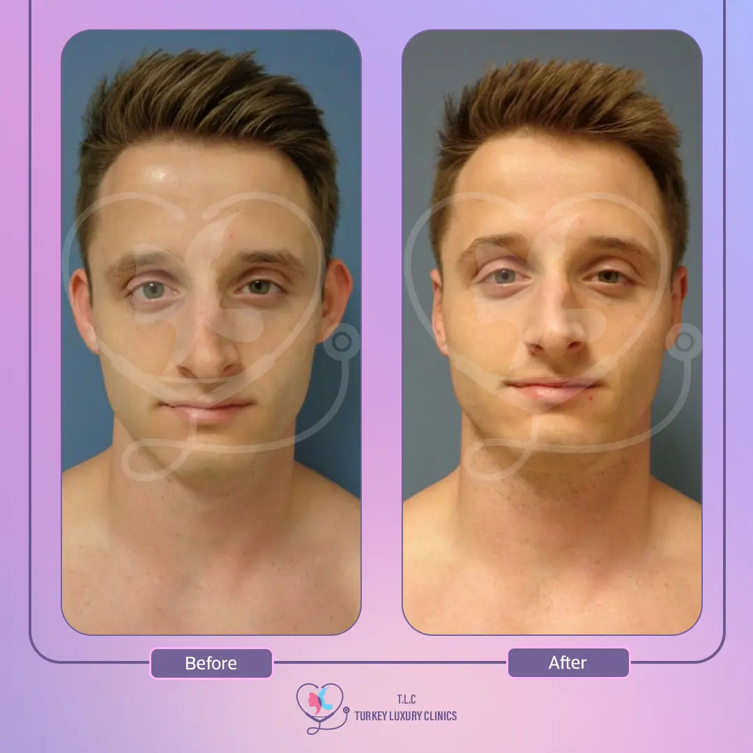 العوامل التي تؤثّر على أسعار عملية تجميل الأذن