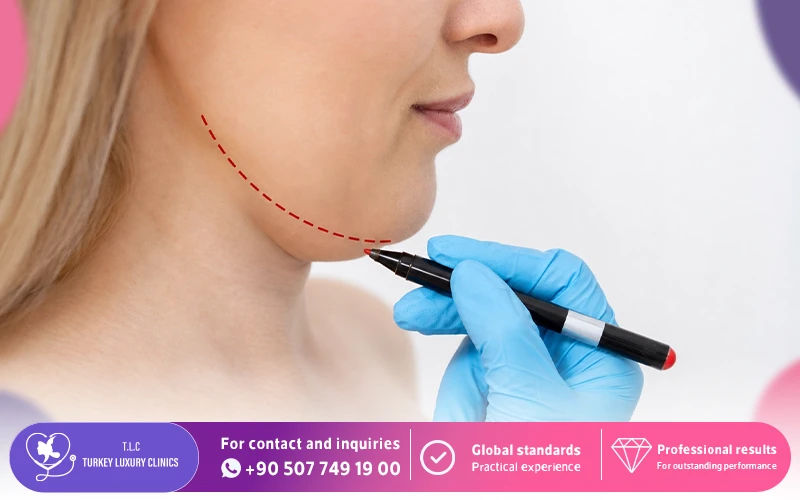 What Chin Liposuction (Submental Liposuction)?