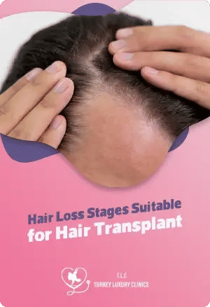 Hair Loss Stages Suitable for Hair Transplant: When Is the Right Time?