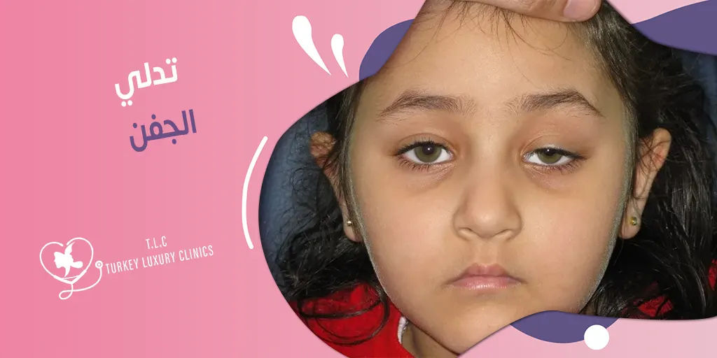 تدلي الجفن: الأسباب وخيارات العلاج الجراحية والطبية