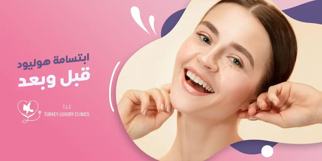 ابتسامة هوليود قبل وبعد