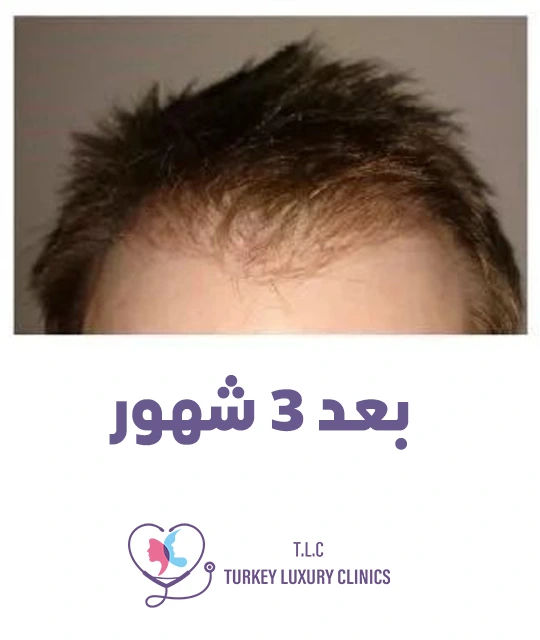 مرحلة الراحة (1-3 أشهر) 