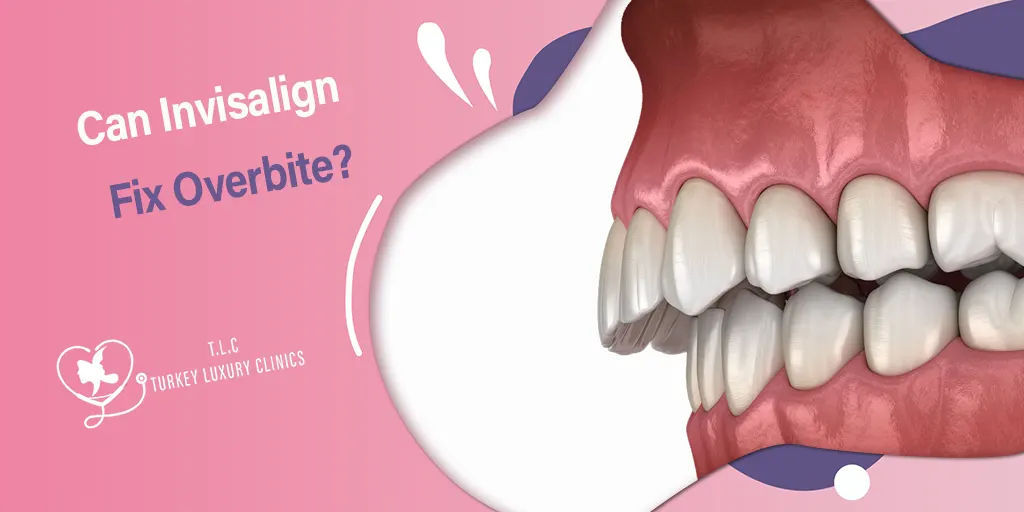 ¿Puede Invisalign Corregir la Sobremordida?