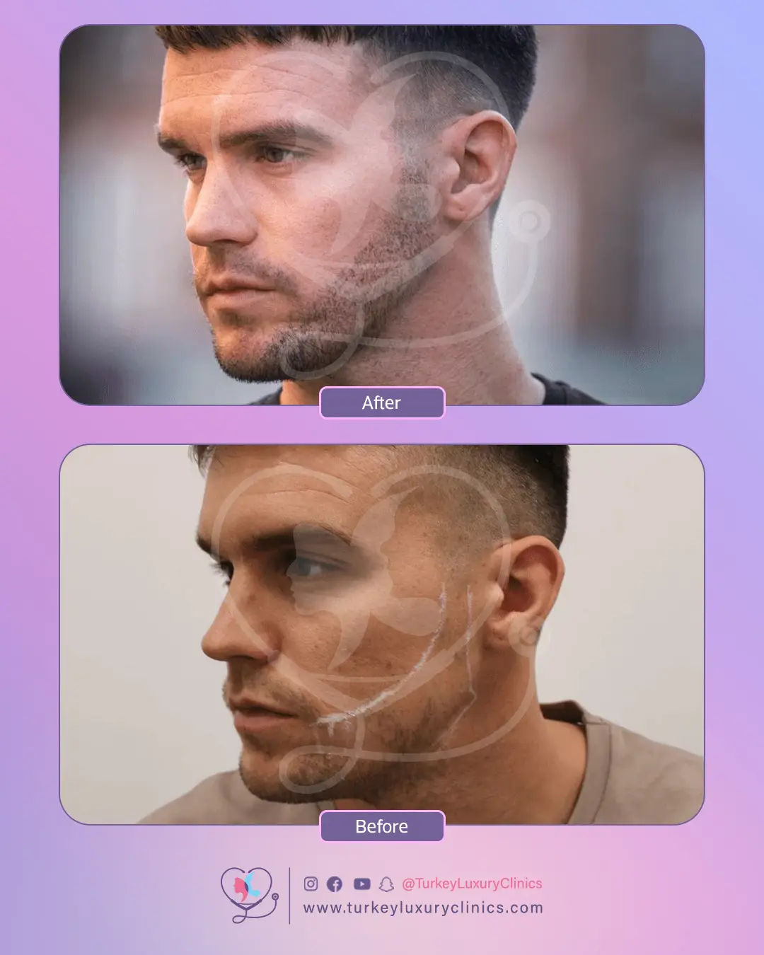 Greffe barbe en Turquie : Prix DHI & photos - Devis Gratuit 