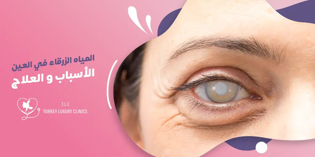 علاج الجلوكوما (الزرق) في تركيا: الأسباب، الأعراض والعلاج