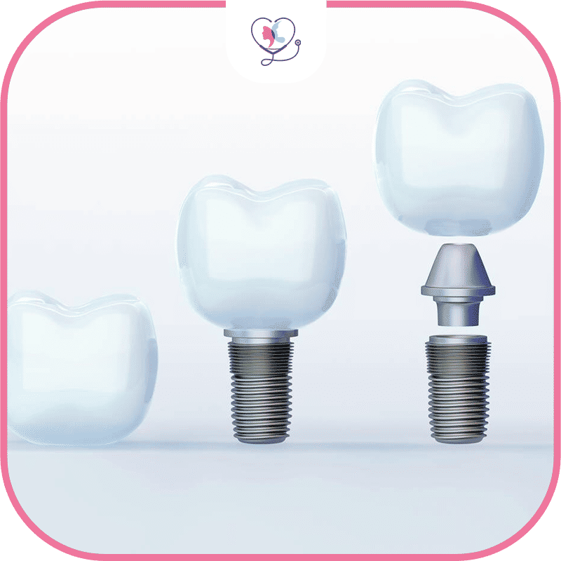 quel-est-l'intérêt-de-l'implant-dentaire-?