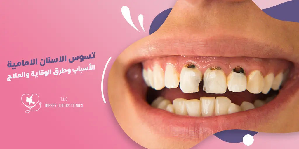 تسوس الاسنان الامامية: الأسباب وطرق الوقاية والعلاج المناسب