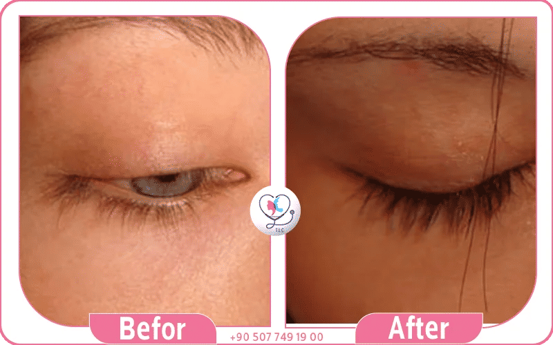 زراعة الرموش زراعة الرموش