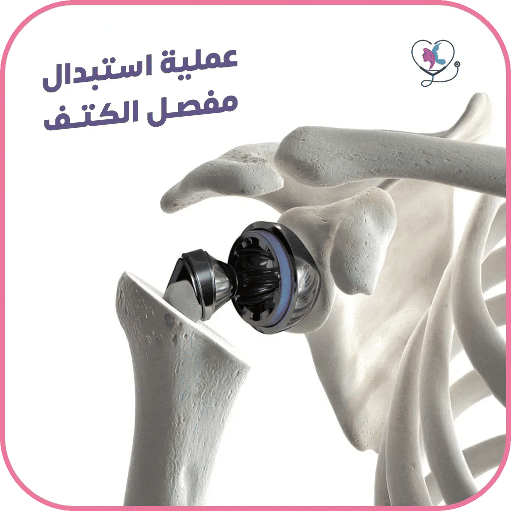 استبدال مفصل الكتف في تركيا