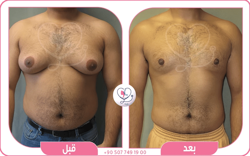 التعافي بعد عملية الجاينو