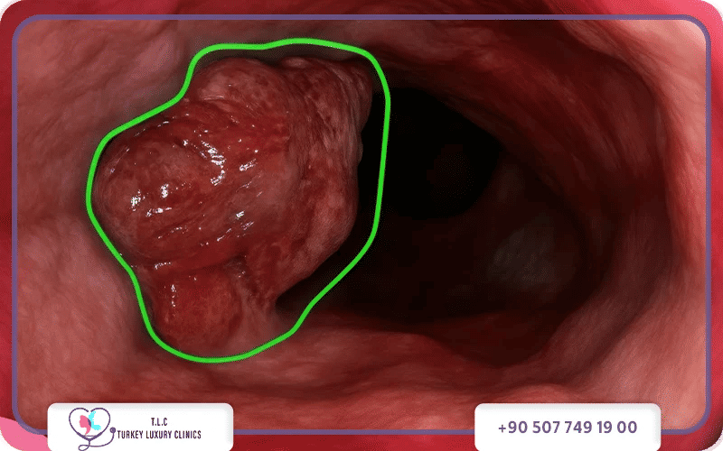 ما هو سرطان المريء؟