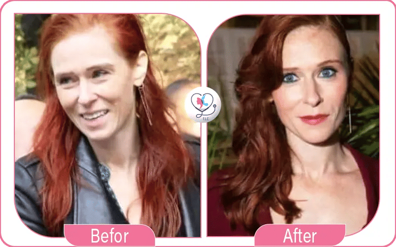 Audrey Fleurot avant / après chirurgie-3