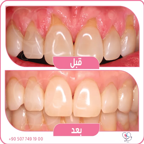  انحسار اللثة