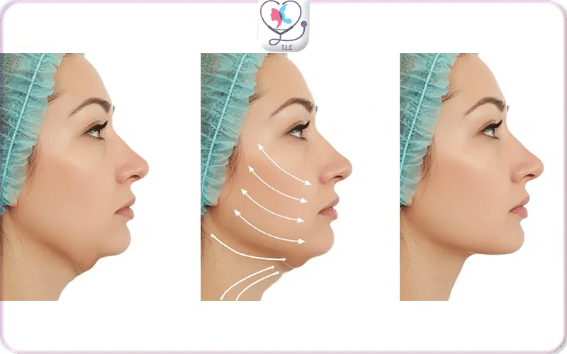 كم تكلفة عملية ازالة اللغلوغ؟