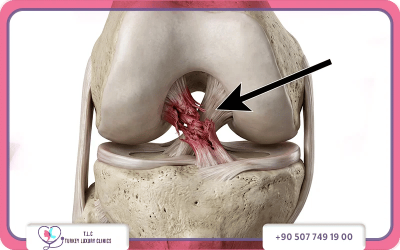 ما الفرق بين قطع وتمزق الرباط الصليبي من حيث الأسباب؟