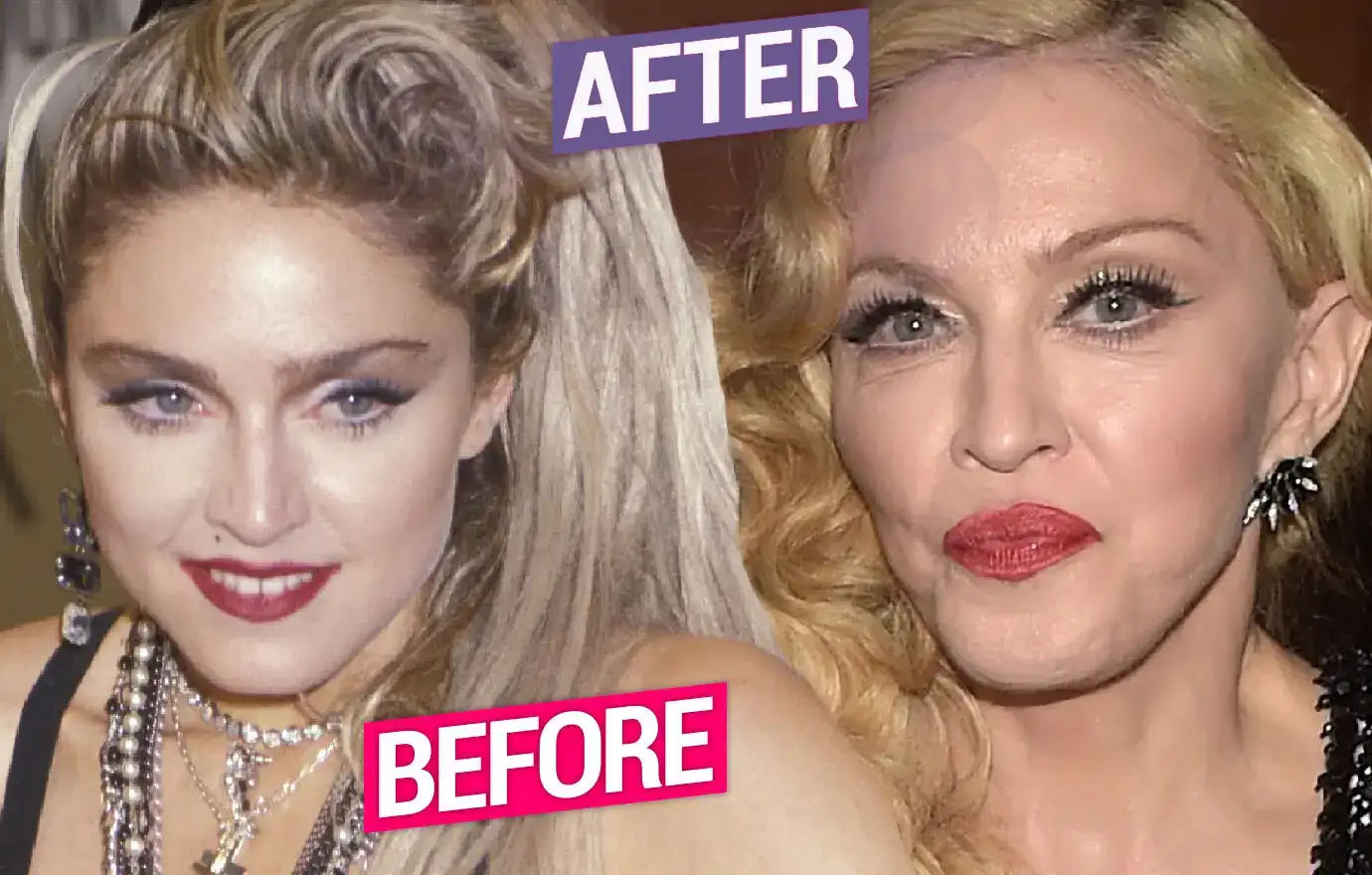Madonna Before and After Plastic Surgery