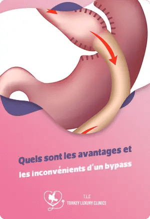 Quels sont les avantages et les inconvénients d'un bypass ?featured image