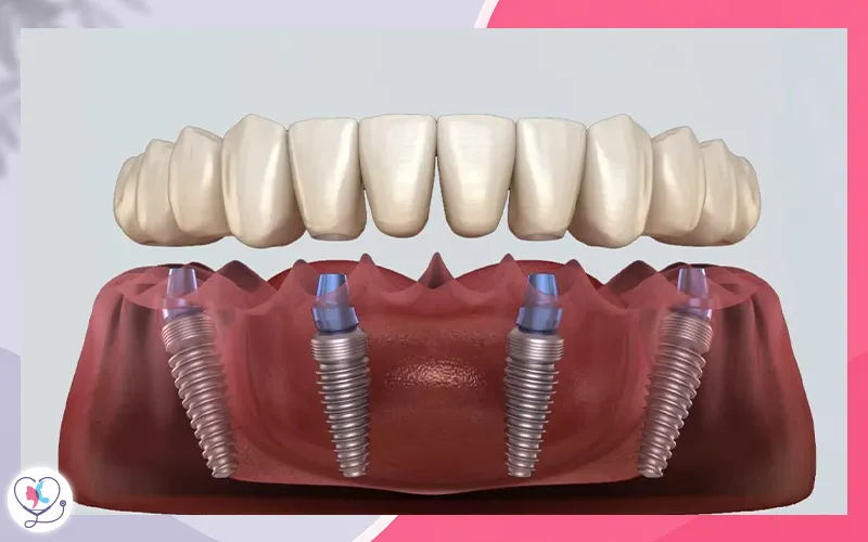 All-on-4 Dental Implants