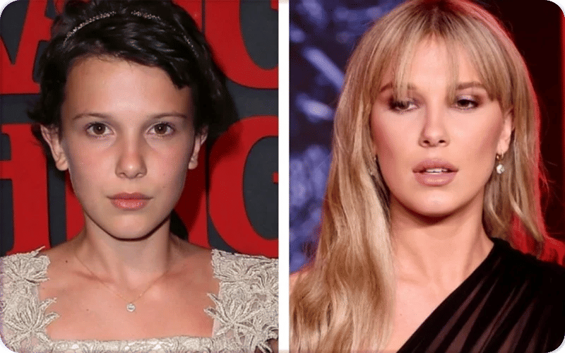 Millie Bobby Brown’s lips highlighted in recent photos, showing possible cosmetic enhancement. Millie Bobby Brown’s lips highlighted in recent photos, showing possible cosmetic enhancement.
