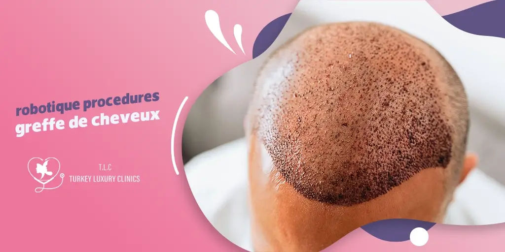 Avantages et inconvénients de la robotique dans les procédures de greffe de cheveux
