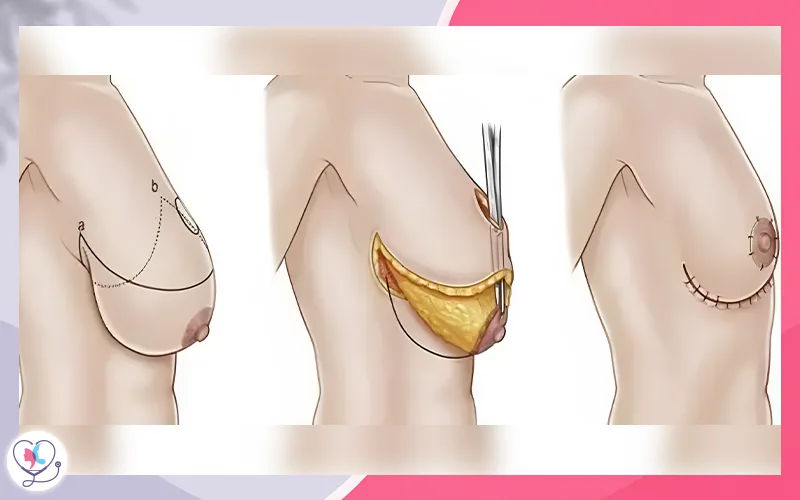 خطوات عملية تصغير الثدي