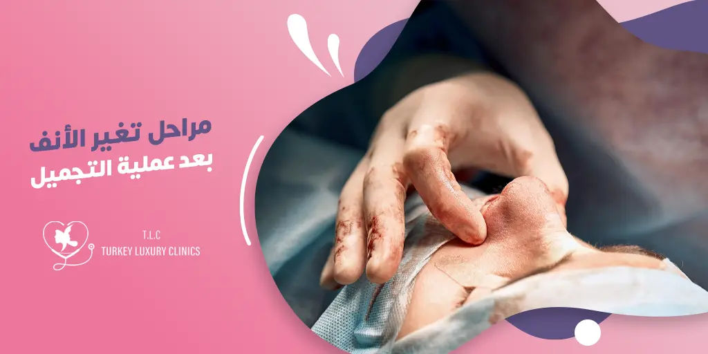 مراحل تغير الأنف بعد عملية التجميل: ماذا تتوقع خلال فترة الشفاء؟