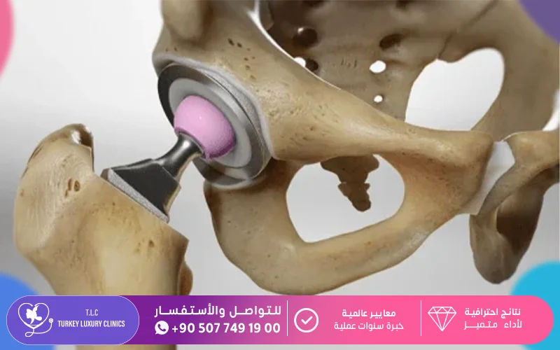 عملية تلبيس مفصل الورك