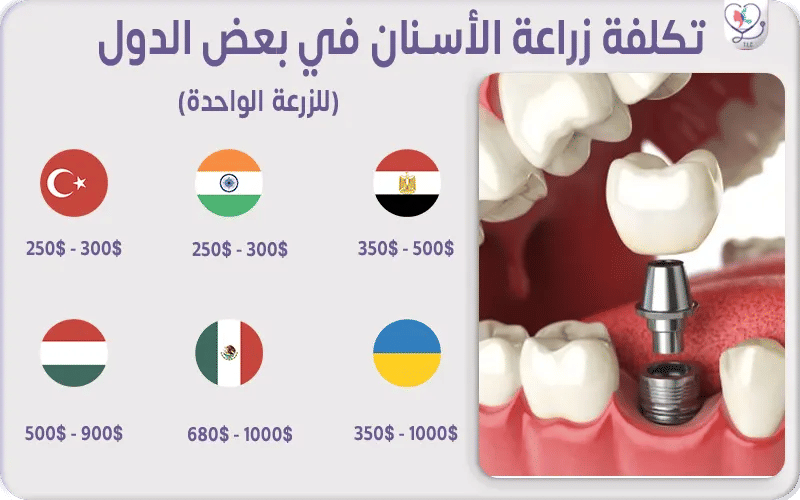 ما هي أرخص دولة في زراعة الأسنان؟