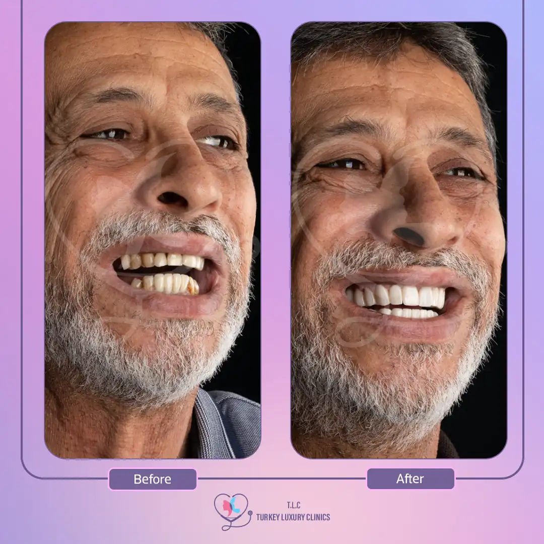 أولاً العناية الفورية بعد تركيب ابتسامة هوليود