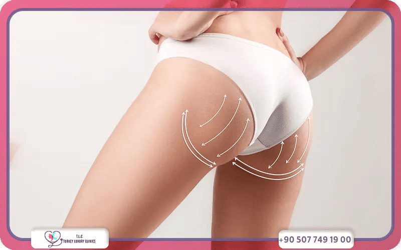 تجربتي مع فيلر المؤخرة في تركيا لاكشري كلينك