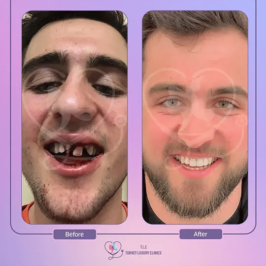 All on 4 Dental Implants Before and After 3