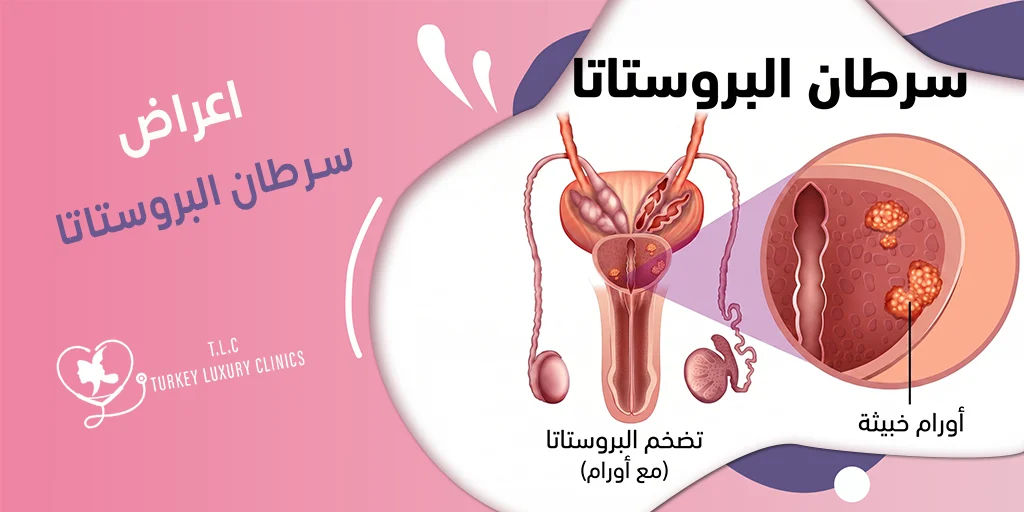 اعراض سرطان البروستاتا: علامات تستوجب الحذر! تعرف عليها