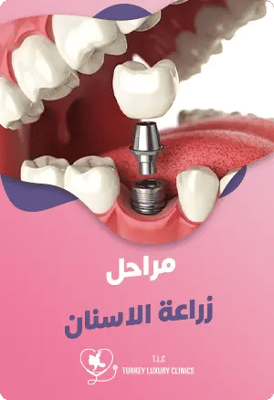 مراحل زراعة الاسنان: دليل كامل يوضح لك الخطوات بالتفصيلfeatured image