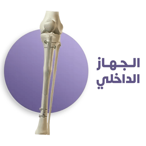 تقنيات زيادة الطول في تركيا-2